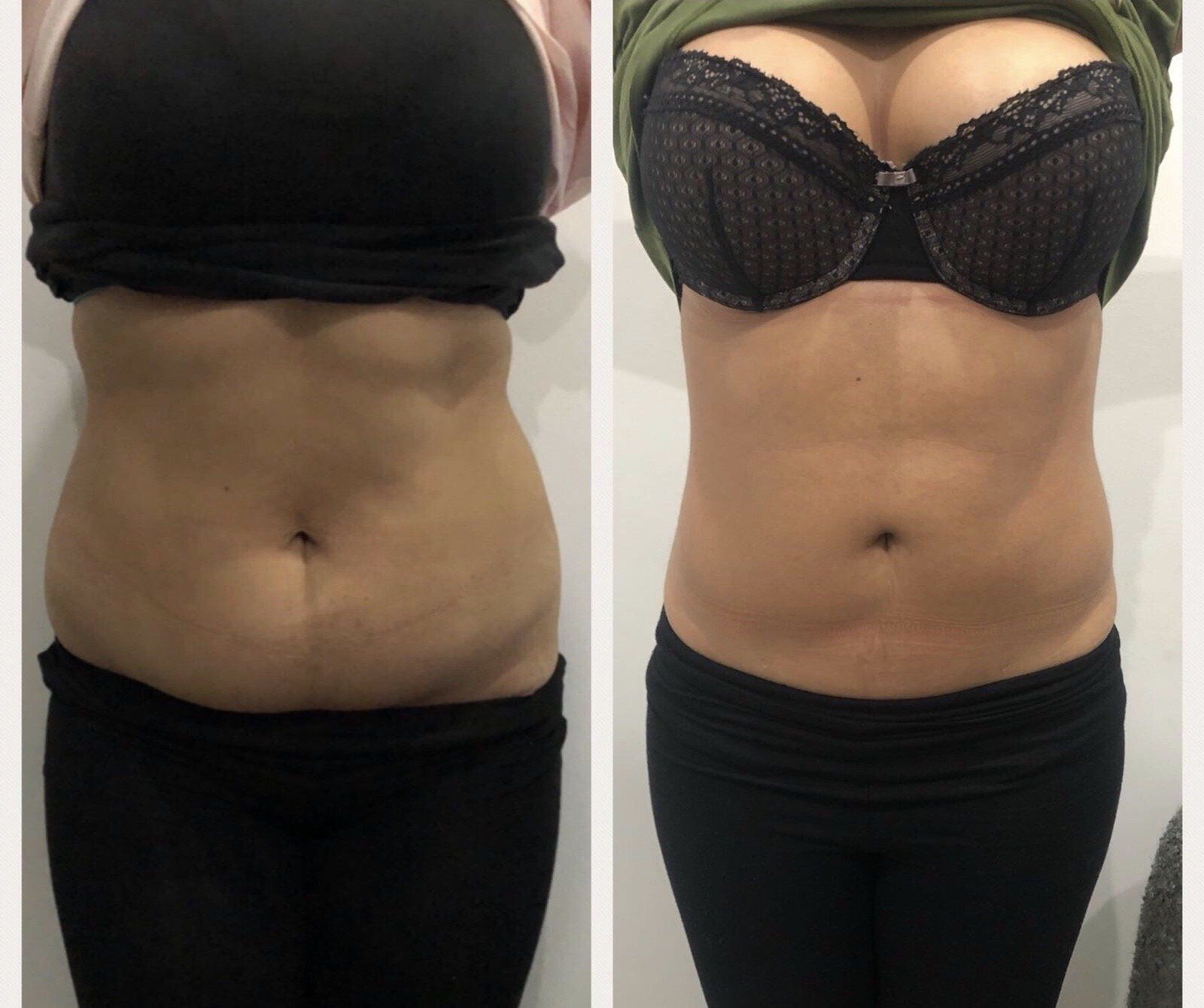 Before and after picture of fat loss on the belly area