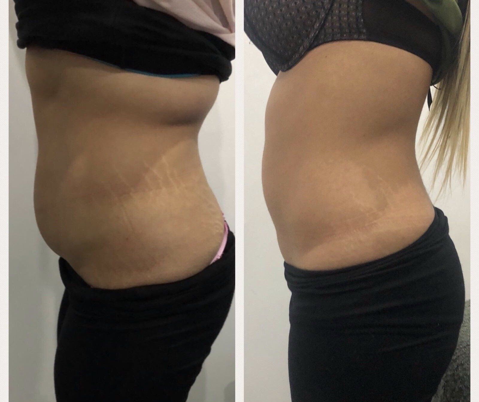 Side by side picture of before and after fat loss treatments showing the belly