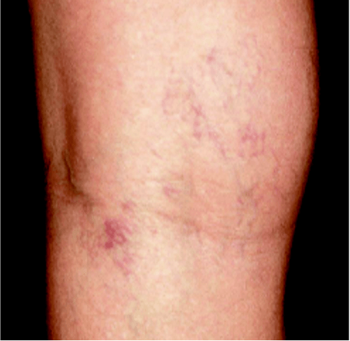 Before and after results of vein removal on the leg