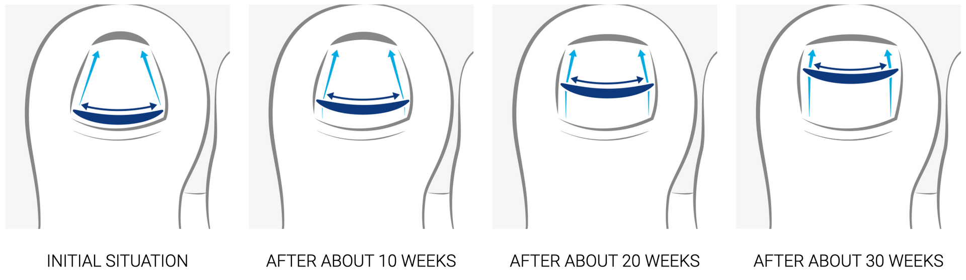 A drawing of a person 's toenails with different stages of growth.
