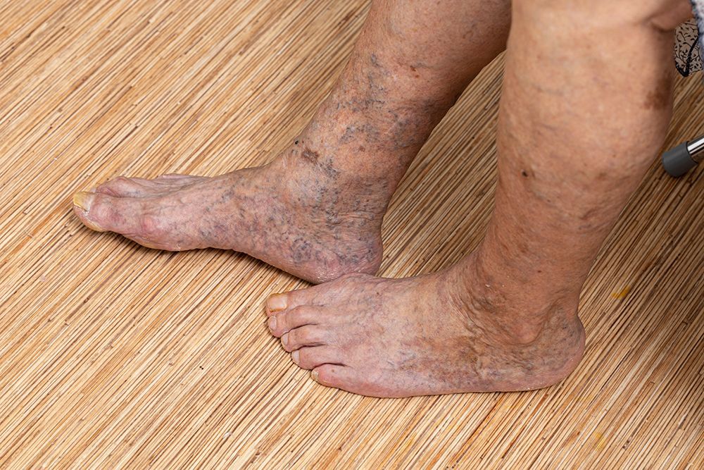 Peripheral Vascular Disease