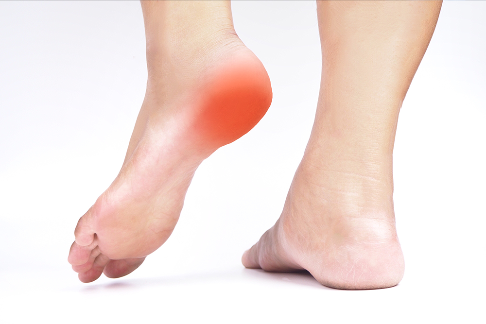 Plantar Fasciitis