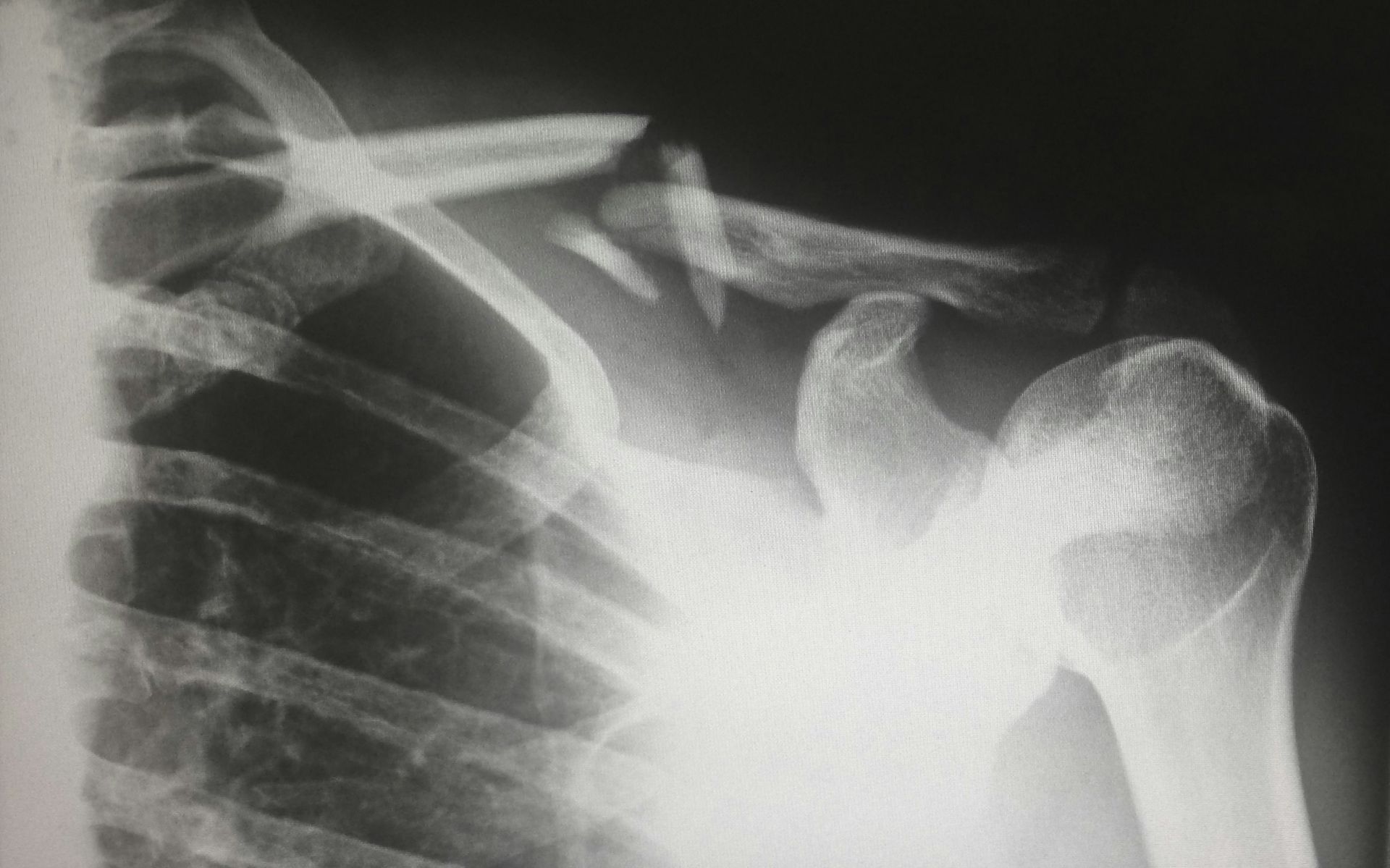 An x-ray of a person 's shoulder with a broken bone.