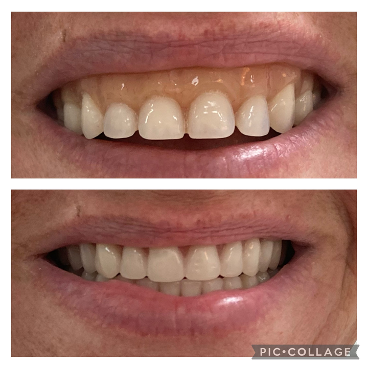 Bradley Before and After Teeth — North Geelong, VIC — Shyne Dental & Denture Clinic