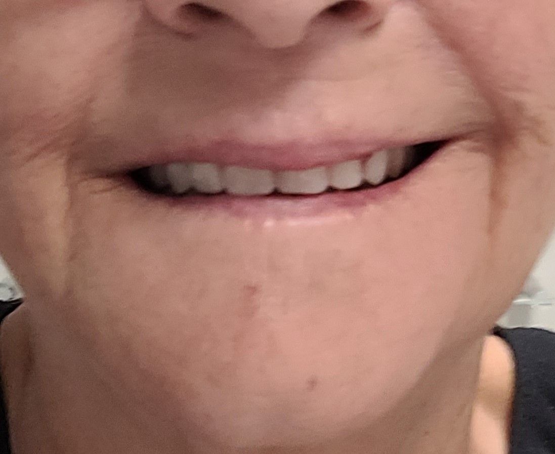 Carol After — North Geelong, VIC — Shyne Dental & Denture Clinic