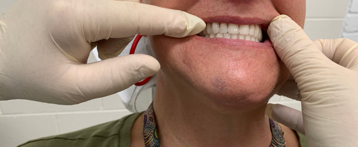 Kelly's New Teeth — North Geelong, VIC — Shyne Dental & Denture Clinic