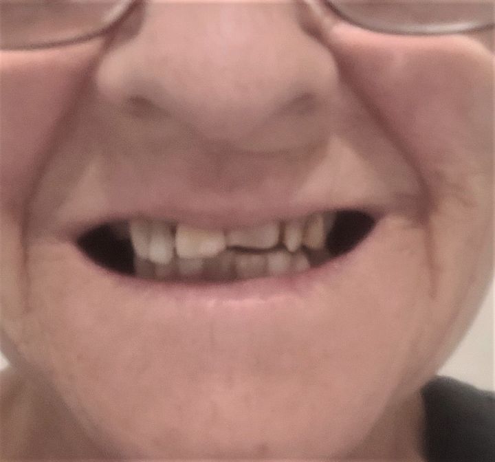 Carol Before — North Geelong, VIC — Shyne Dental & Denture Clinic