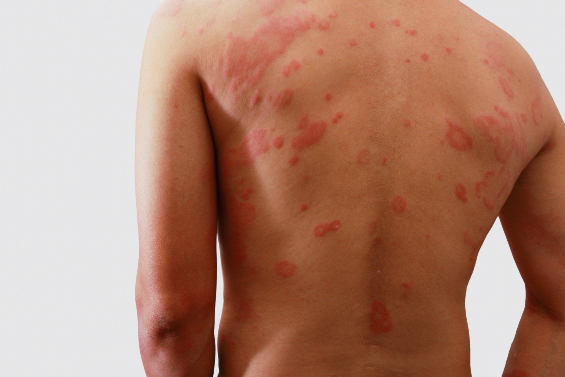 large rash on man's back