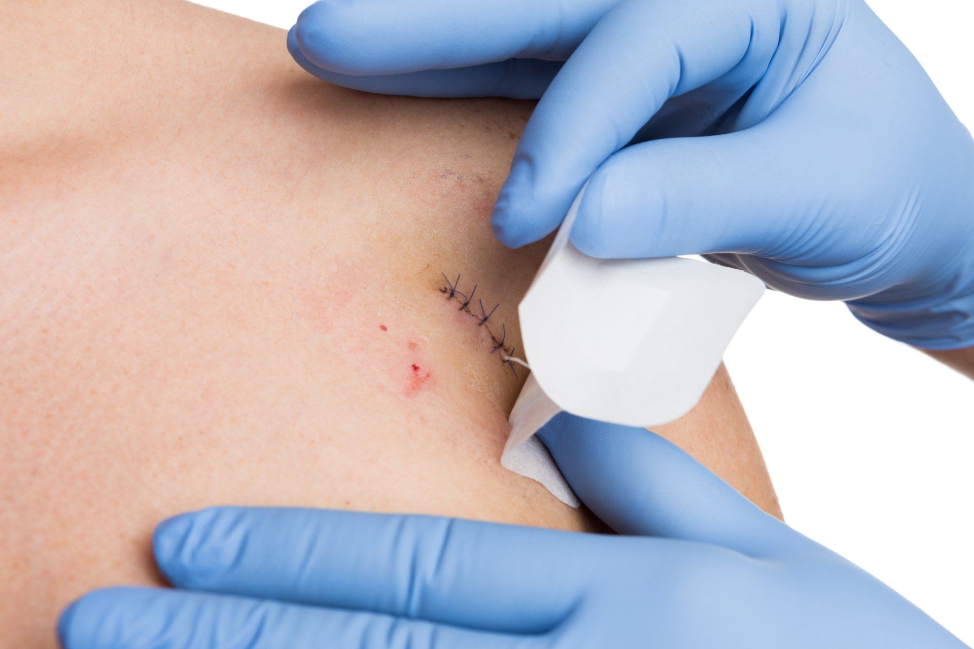 dermatologist applies bandage over skin surgery wound