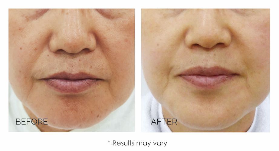 real patient before and after treatment with LUCENT IPL skin rejuvenation device
