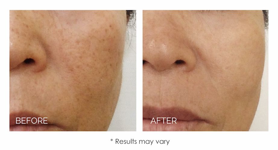 real patient before and after treatment with LUCENT IPL skin rejuvenation device
