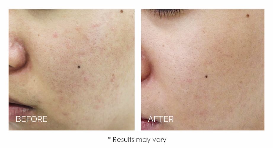 real patient before and after treatment with LUCENT IPL skin rejuvenation device