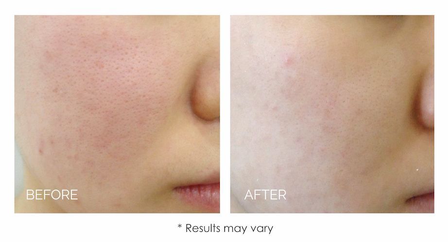 real patient before and after treatment with LUCENT IPL skin rejuvenation device