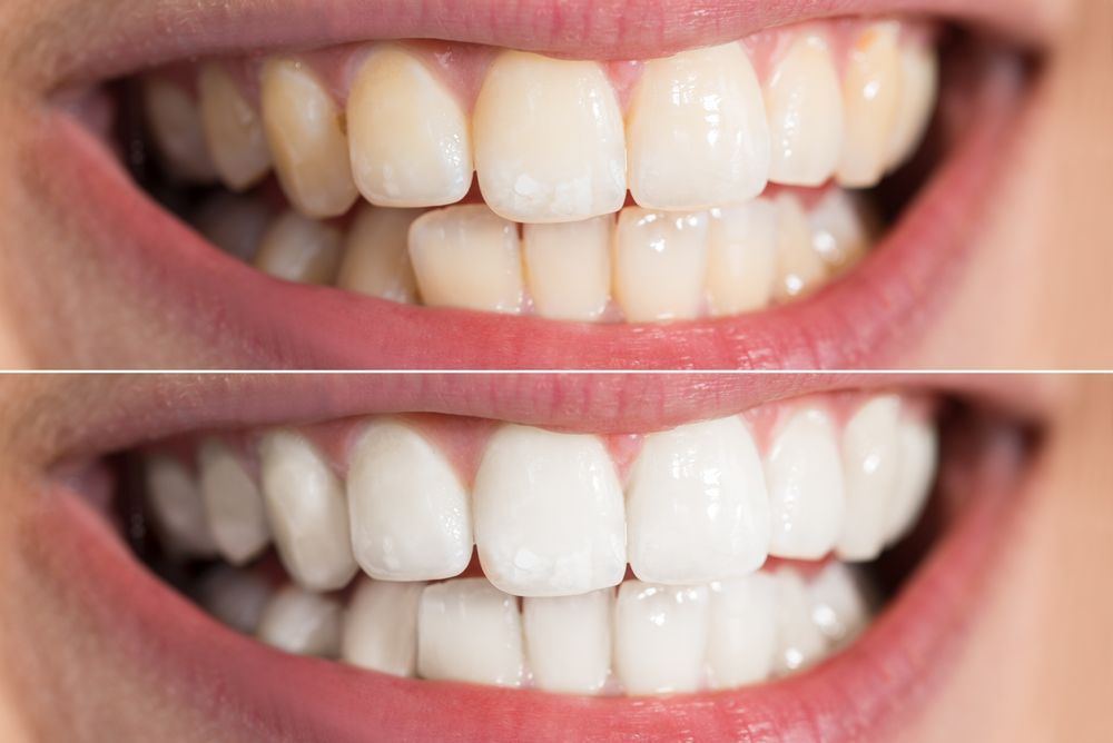 A Before And After Photo Of A Persons Teeth — Alice Denture Clinic In Ciccone, NT