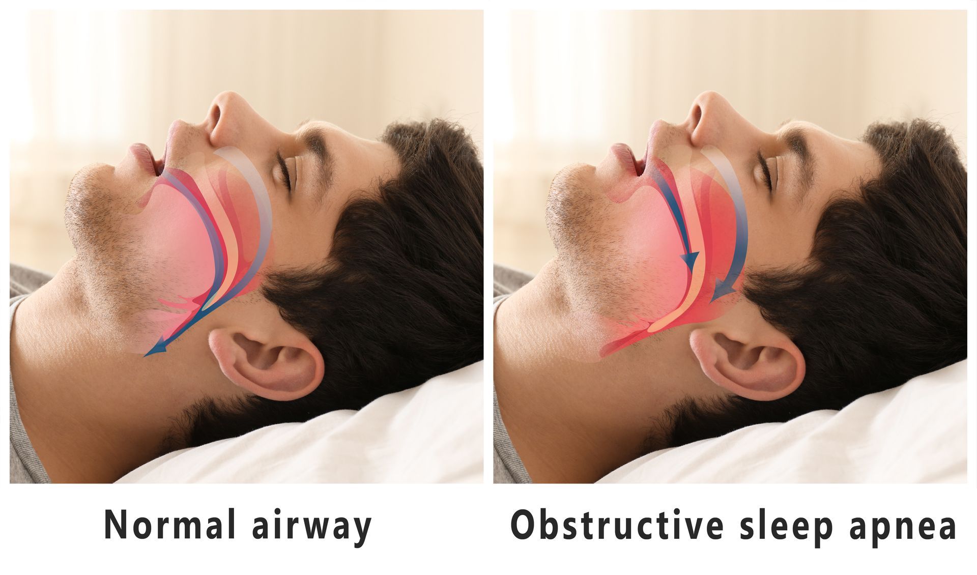 Side-by-side diagram showing normal airway and obstructive sleep apnea in a sleeping person