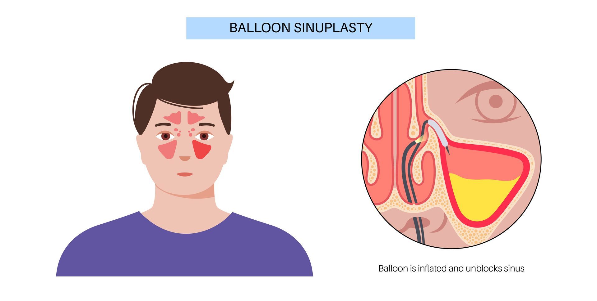 Person with red facial rash beside a nasal cavity diagram labeled “balloon sinuplasty.”