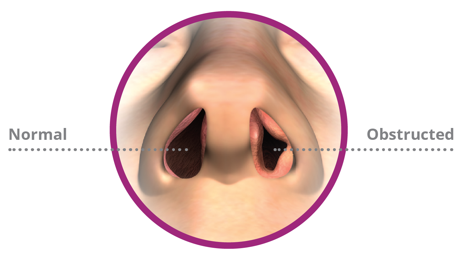 Illustration of normal nostrils and obstructed or congested nostrils
