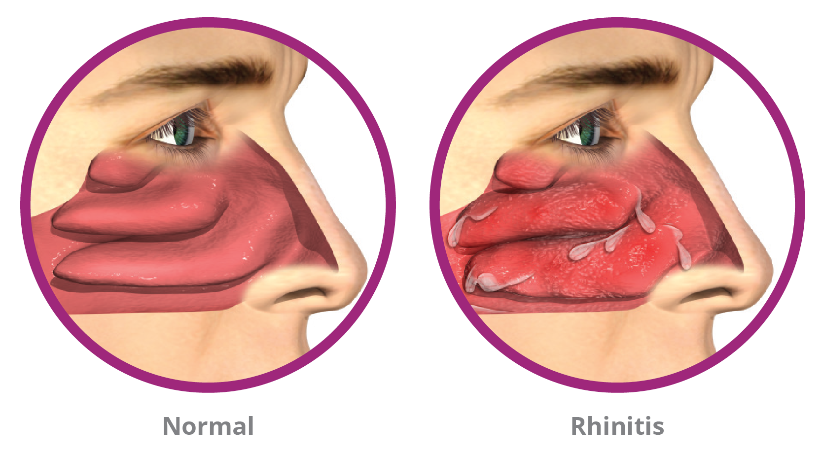Illustration of normal nasal passages and rhinitis