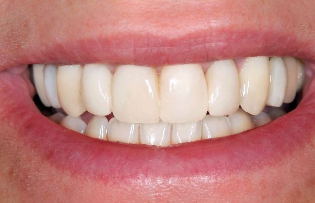 cosmetic dentistry after
