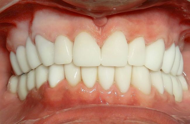 Dentures/Partials after