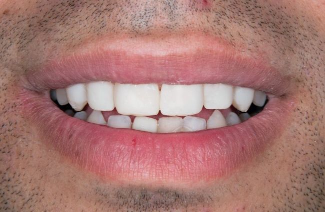 Invisalign after