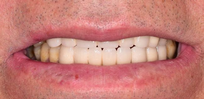 smile reconstruction after