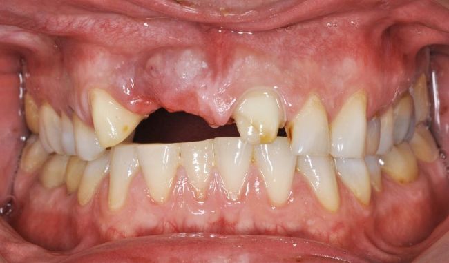Dentures/Partials before