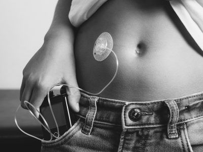 A black and white photo of a person with an insulin pump on their stomach