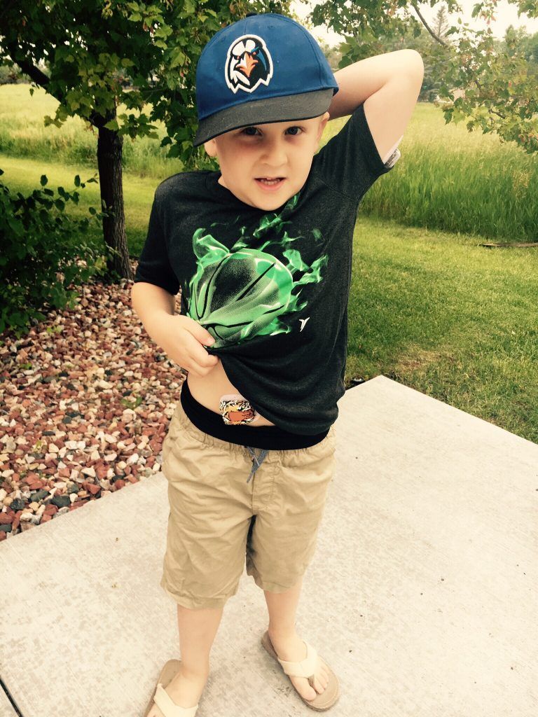 Young boy showing his insulin pump attached to his stomach.
