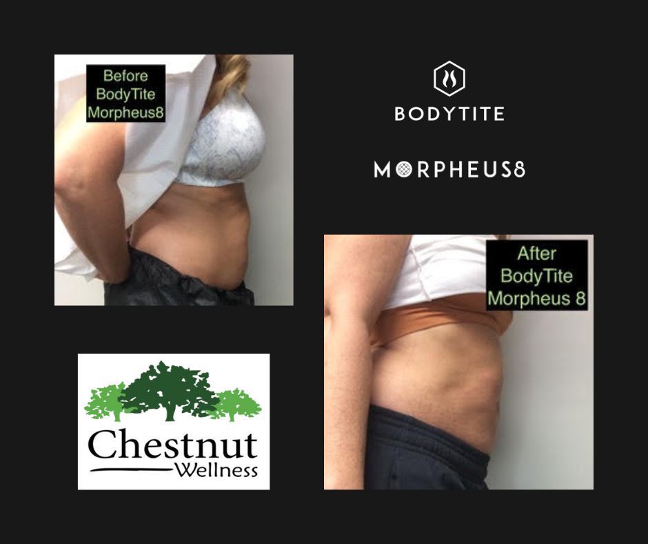 A woman 's stomach is shown before and after a bodytite morpheus 8 treatment.