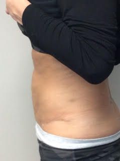 a woman in a black shirt and white underwear 3 months after lipo, bodytite and Morpheus8 treatments.