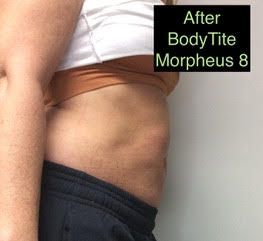 a woman 's stomach is shown after a bodytite morpheus 8 treatment .