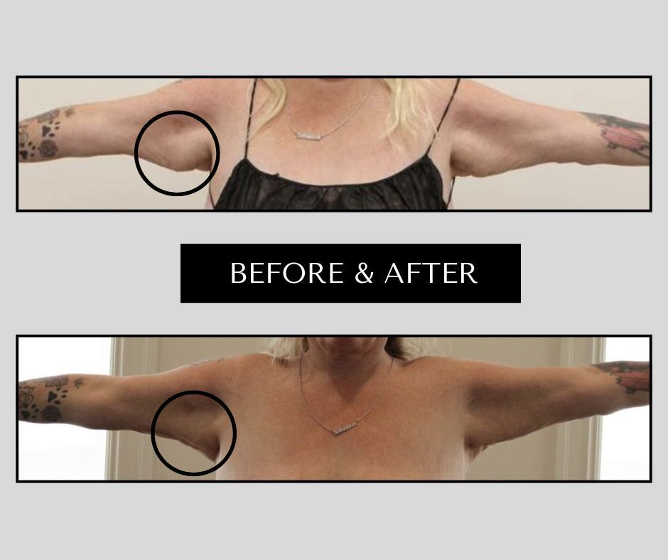 A before and after photo of a woman 's arms