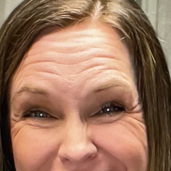 A close up of a woman 's face with wrinkles on her forehead