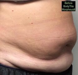 a woman 's stomach is shown after a bodytite morpheus 8 treatment .