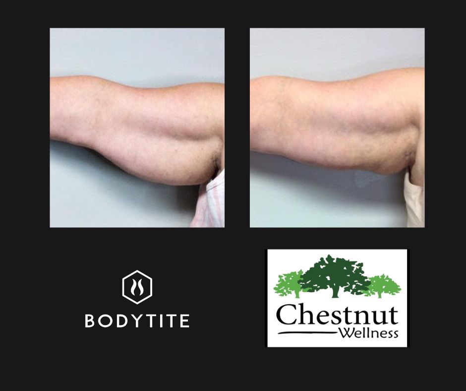 A before and after photo of a woman 's arm with chestnut wellness in the corner