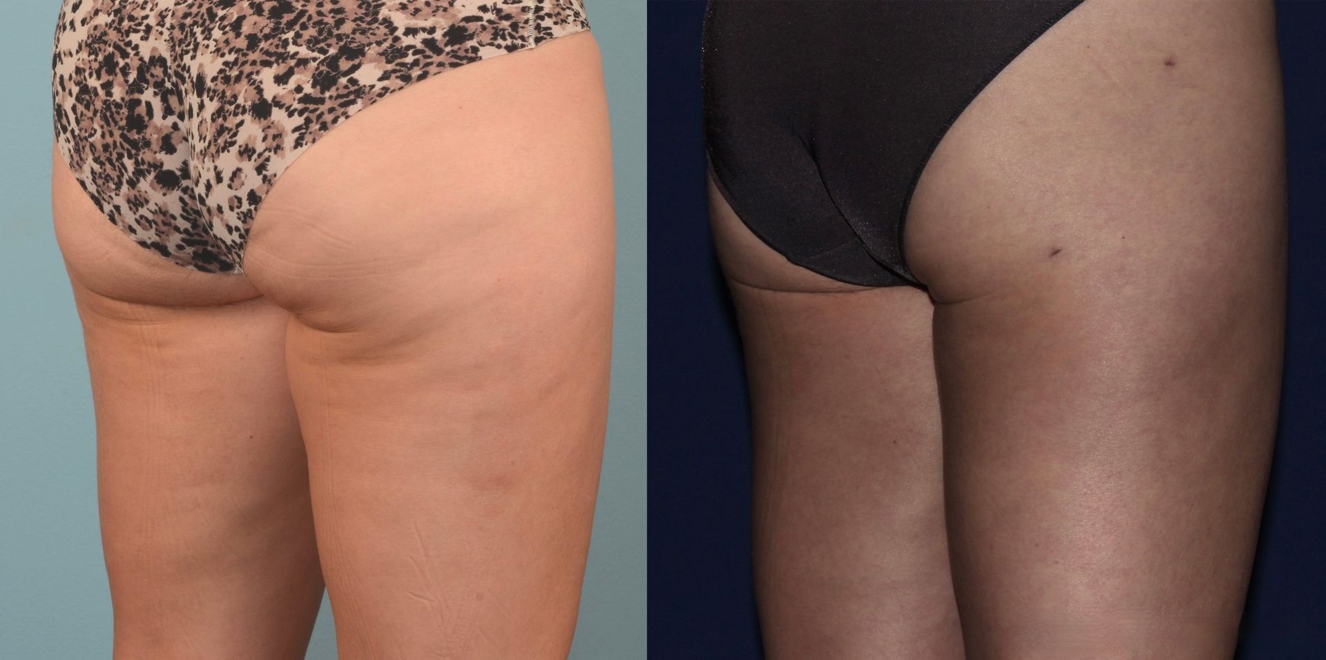 liposuction and morpheus8 before and after photos of a woman's rear
