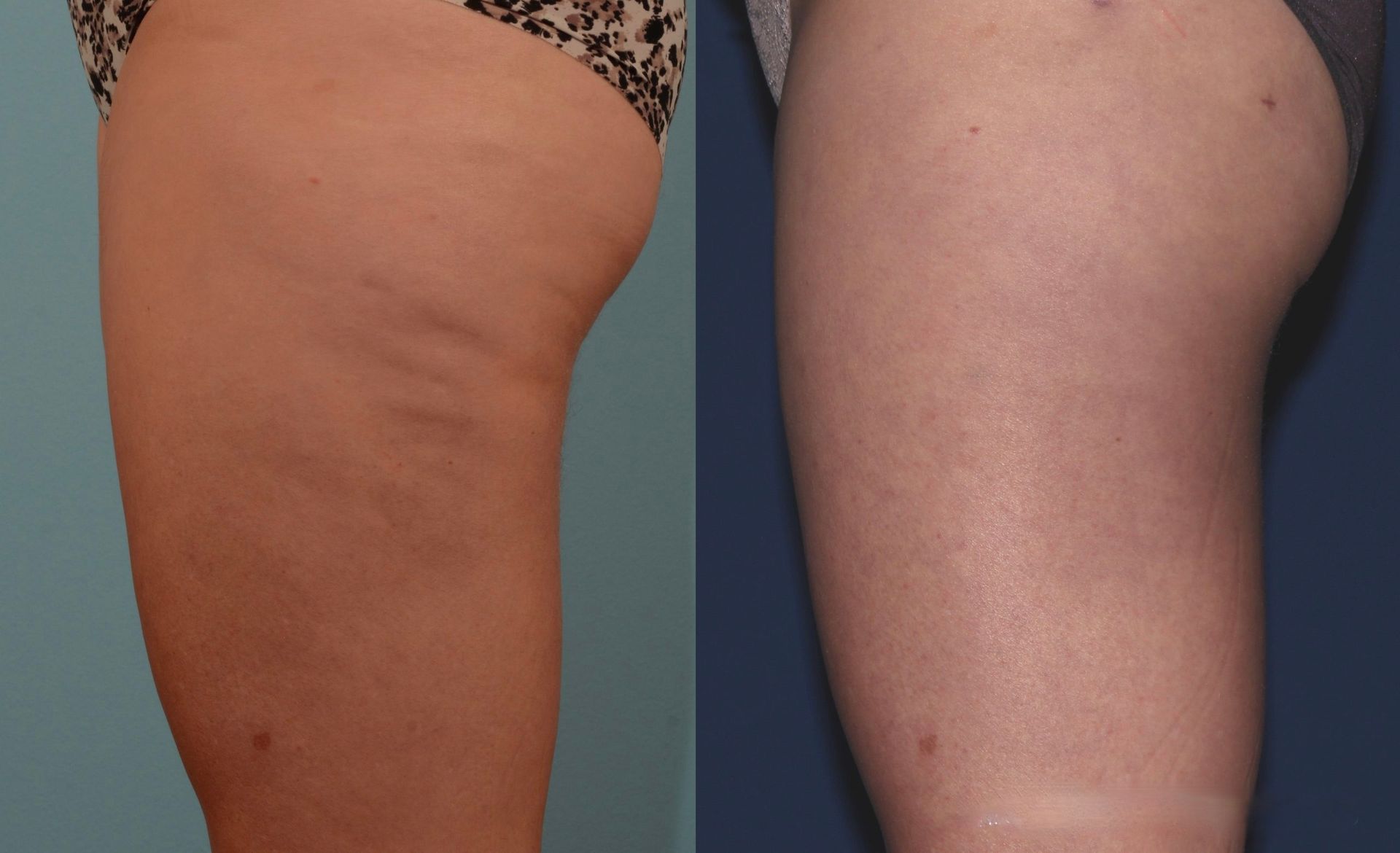 liposuction before and after photos of a woman