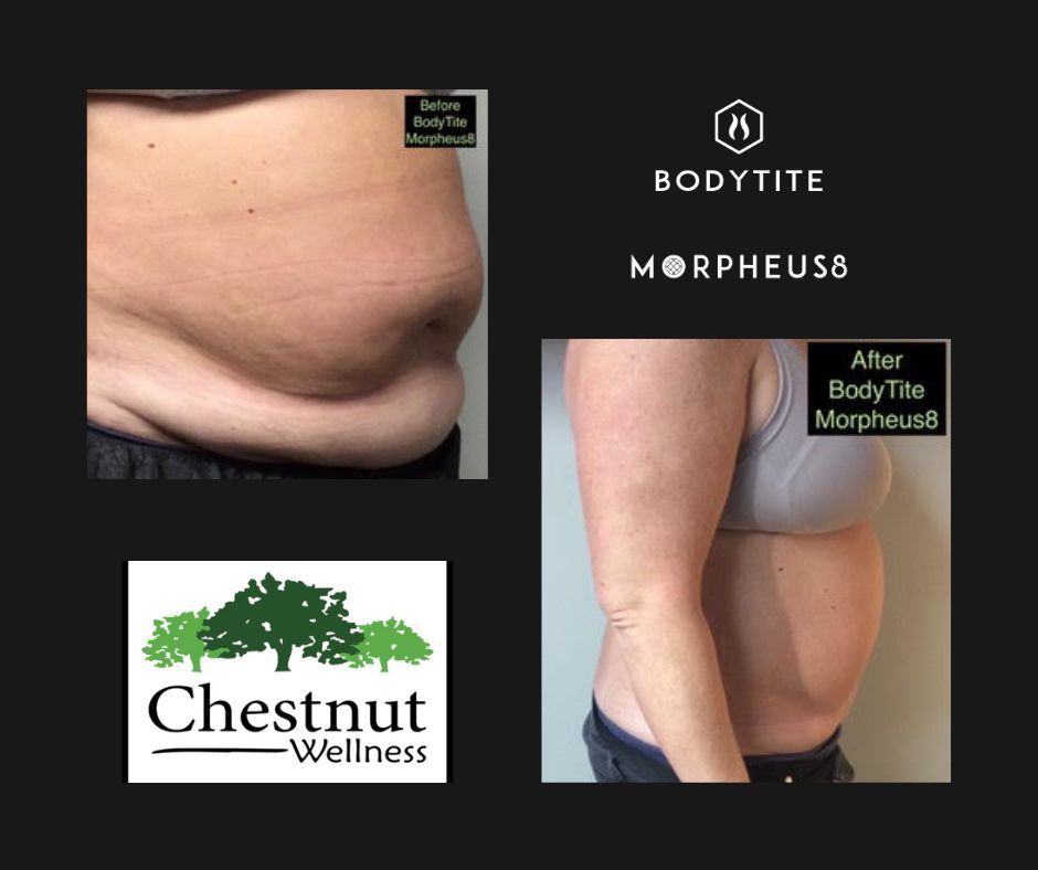 A before and after photo of a woman 's stomach and chestnut wellness logo