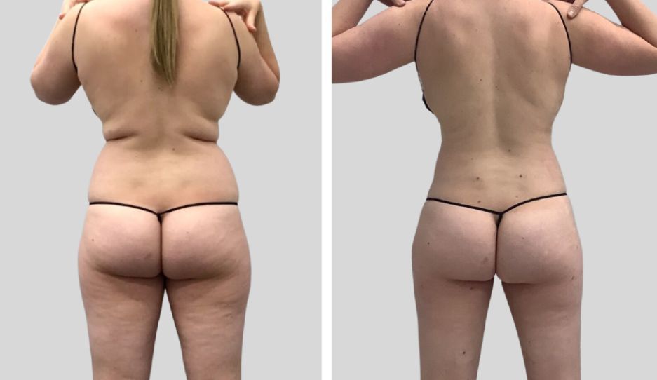 A before and after picture of a woman 's back