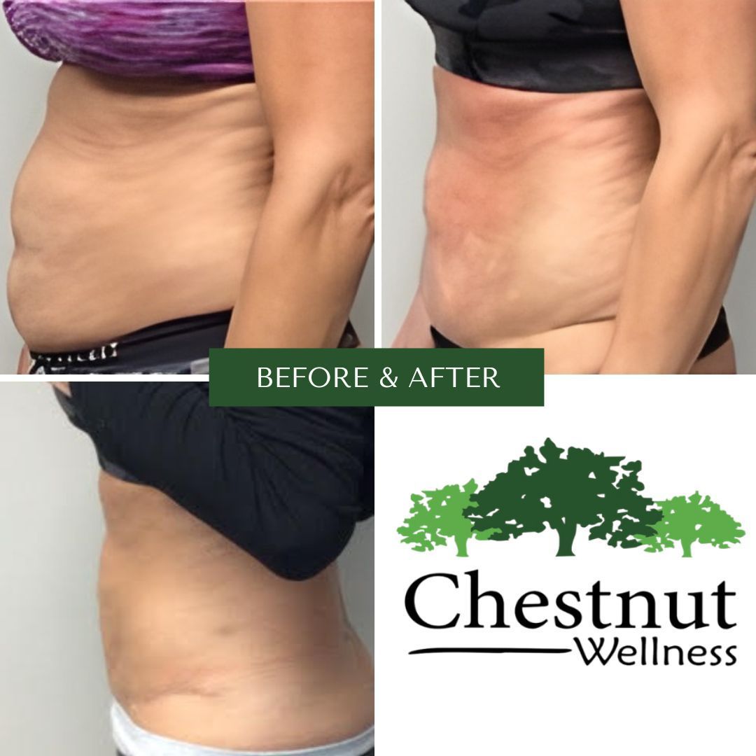 A before and after photo of a woman 's stomach for chestnut wellness