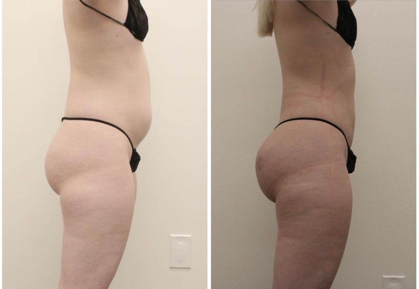 liposuction before and after photos of a woman