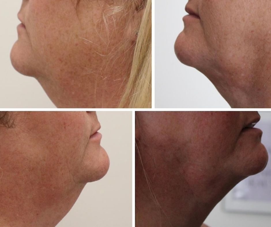 A woman 's neck is shown before and after a procedure