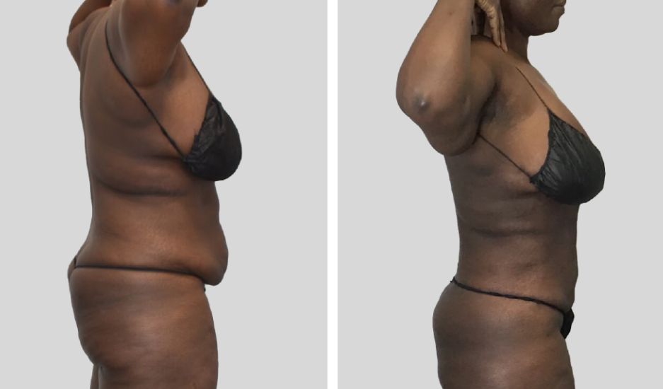 A before and after photo of a woman 's body