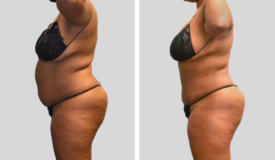 A woman in a bikini is shown before and after losing weight.