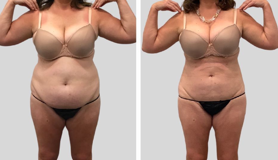A before and after photo of a woman 's stomach in a bra.