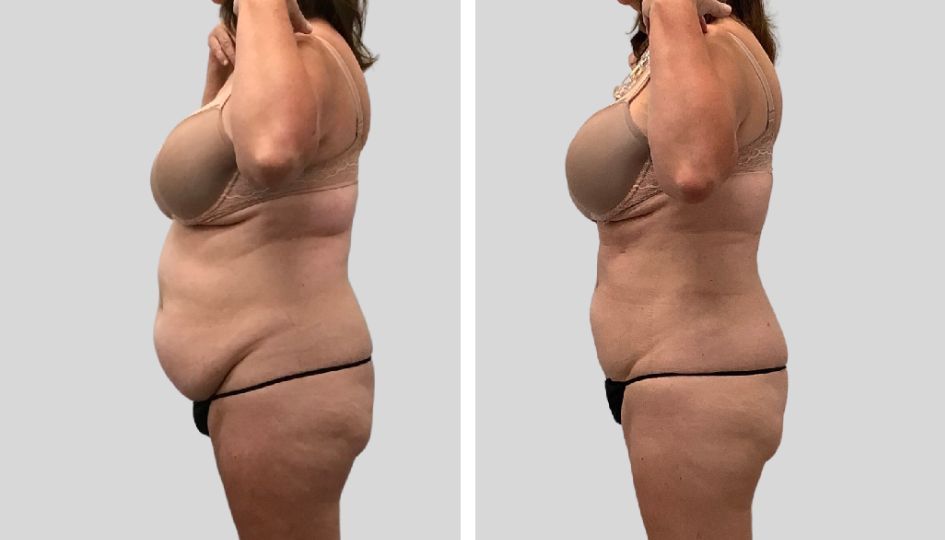 A before and after photo of a woman 's stomach.