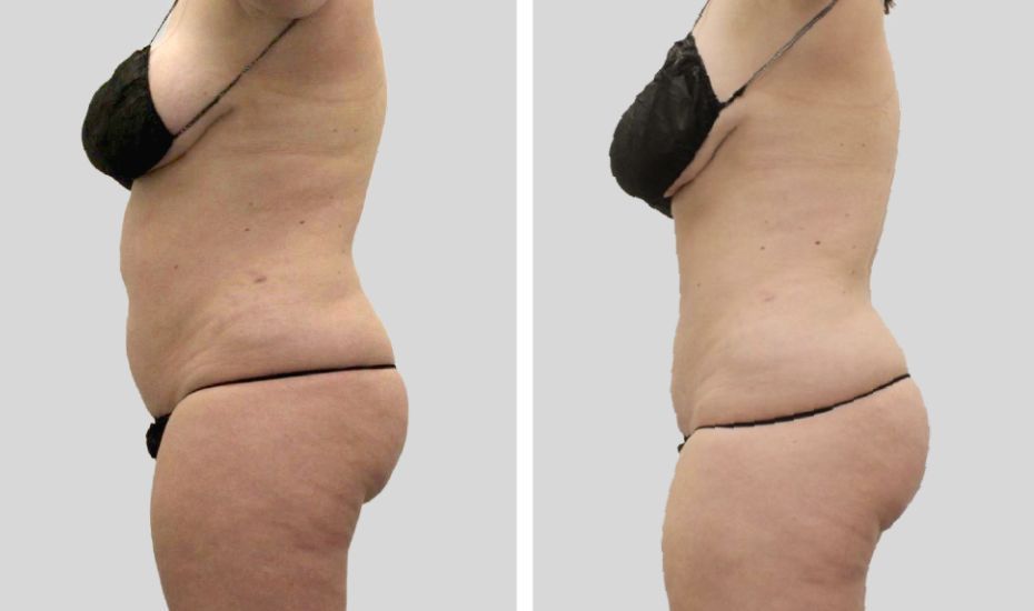 A woman 's torso is shown before and after surgery.