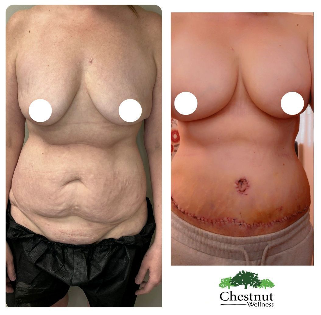 A before and after picture of a woman's tummy tuck
