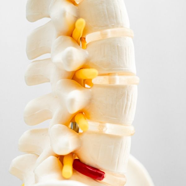 A close up of a model of a spine displaying degenerative disc